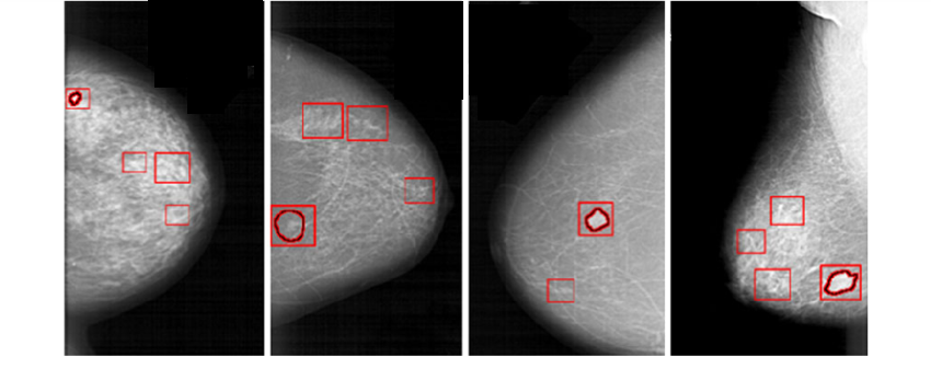 MAMMOGRAPHY
